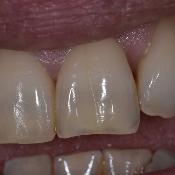 post-extractive implant | ADVAN Implantology